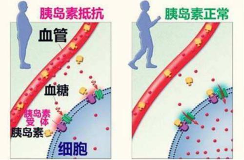 胰岛素抵抗新突破：治愈之光，健康未来在望！