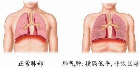 病退政策新调整：最新退休疾病认定标准及实施细则全解析